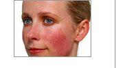 Rosacea eltvoltsa villanfnyes lzerrel